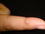 Бородавки на пальцах рук: симптомы, причины, способы лечения