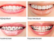 Эволюция методов исправления зубов
