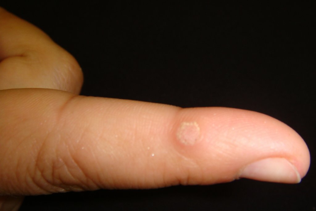 Бородавки на пальцах рук: симптомы, причины, способы лечения